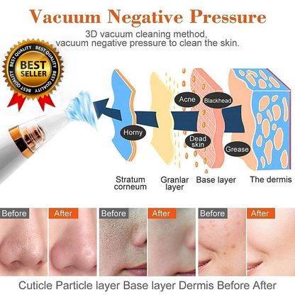 Careit™ Blackhead & whitehead Remover Tool