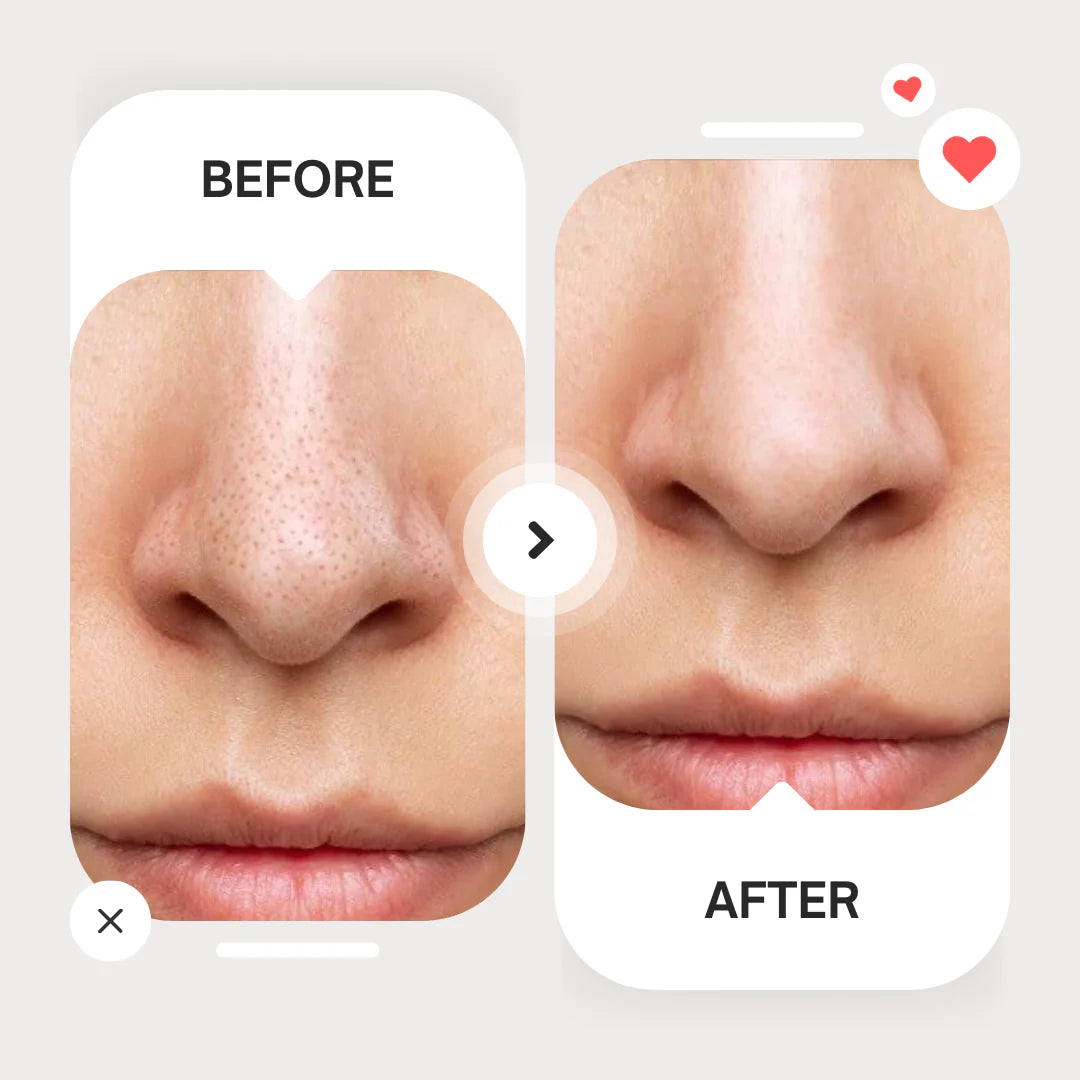 Careit™ Blackhead & whitehead Remover Tool