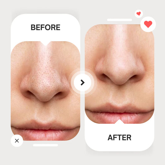 Careit™ Blackhead & whitehead Remover Tool